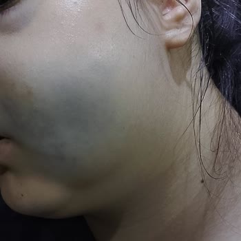 Steril Olmayan Ortam Ve Doktor İhmalinden Kaynaklanan Ciddi Sağlık Sorunu