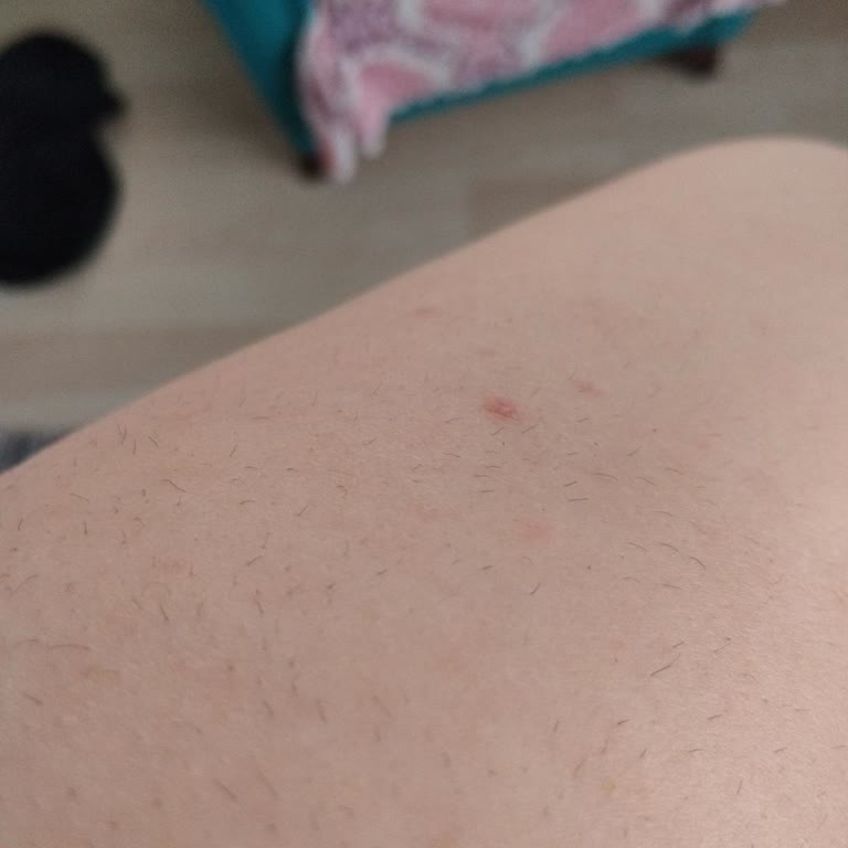 Lazer Epilasyon Hizmetinde Cihaz Değişikliği Ve Sonuçsuz Tedavi Nedeniyle Büyük Hayal Kırıklığı