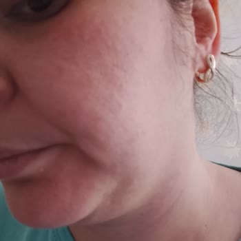 L'Oréal Paris Kırışık Karşıtı Krem Alerjik Reaksiyona Sebep Oldu