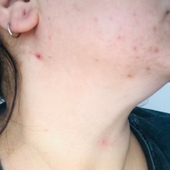 Kullandığım Üründen Beklenen Etkiyi Göremedim, Cildimde Sorunlar Arttı