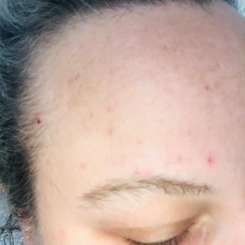 Kullandığım Üründen Beklenen Etkiyi Göremedim, Cildimde Sorunlar Arttı