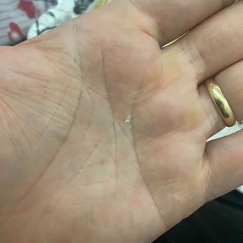 Dondurma İçinden Yabancı Cisim Çıkması Ve Yetersiz Algida Çözümü