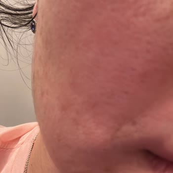 Solgar Supplements Caused Skin Reaction