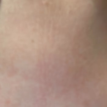 Solgar Supplements Caused Skin Reaction