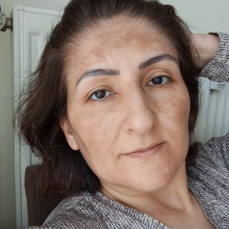 Rengin Bilgici Beauty Yüzümdeki Lekeler Arttı Psikolojim Bozuldu