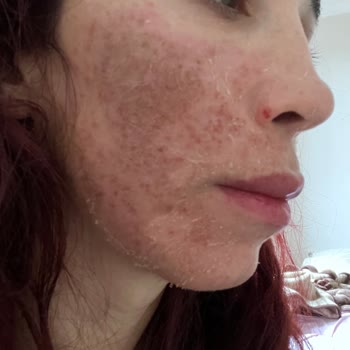 Peeling Sonrası Yüzümde Sivilceler Çıktı, Mağduriyetim Giderilmiyor