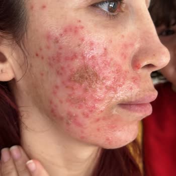 Peeling Sonrası Yüzümde Sivilceler Çıktı, Mağduriyetim Giderilmiyor