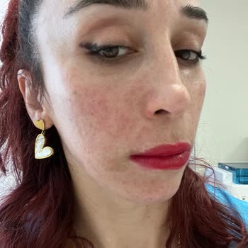 Peeling Sonrası Yüzümde Sivilceler Çıktı, Mağduriyetim Giderilmiyor