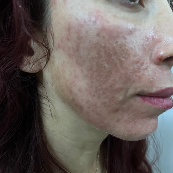 Peeling Sonrası Yüzümde Sivilceler Çıktı, Mağduriyetim Giderilmiyor