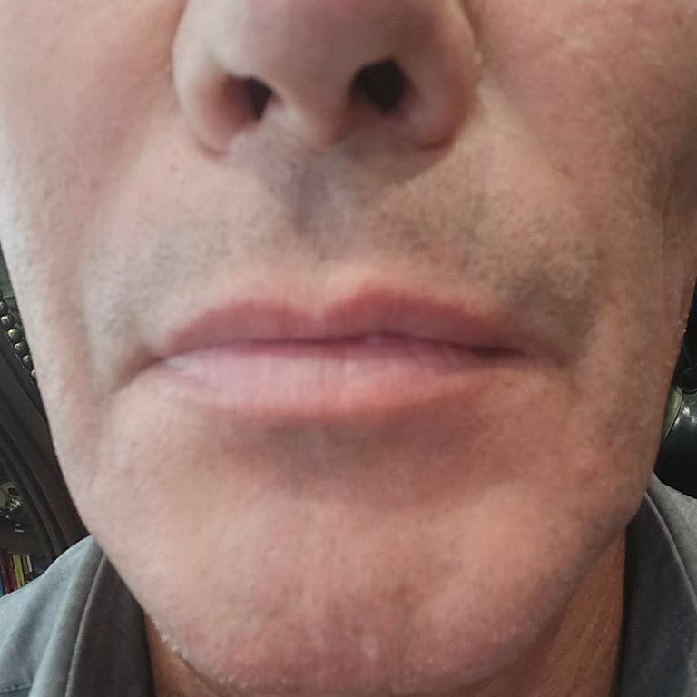 Yüksek Ücretli Ameliyatta Estetik Sorun Ve Fatura Verilmemesi