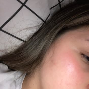 C Vitaminli Kil Maskesi Cildimde Yanma Ve Kızarıklık Yaptı