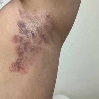 Lazer Uygulaması Sonrası Cilt Yanıkları Ve Yetersiz Destek