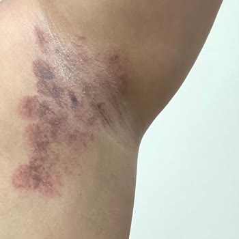 Lazer Uygulaması Sonrası Cilt Yanıkları Ve Yetersiz Destek