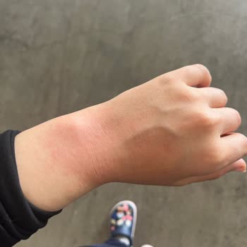 Alerji Yapan Ürünü İade Edemiyorum, Mağdur Oldum