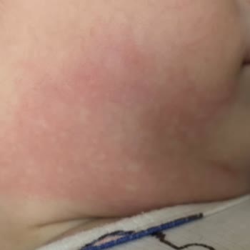 Tetagil Alerji Yaptı