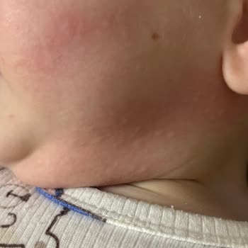 Tetagil Alerji Yaptı