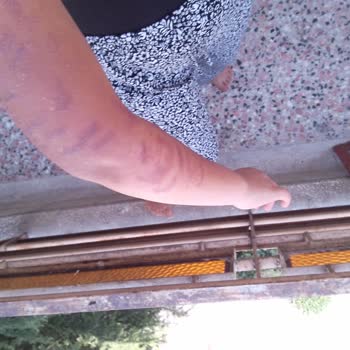 Lazer İşleminde Kolum Yandı Uzmanlık Yok