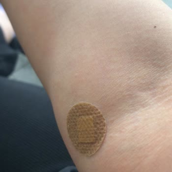 Yanlış Kan Alımı Sonucu Kolumda Morarma Oluştu