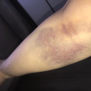 Yanlış Kan Alımı Sonucu Kolumda Morarma Oluştu