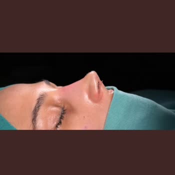 Baypark Hospital Bayrampaşa Estetik Operasyon Sonrası Beklentilerimi Karşılamayan Burun Şekli