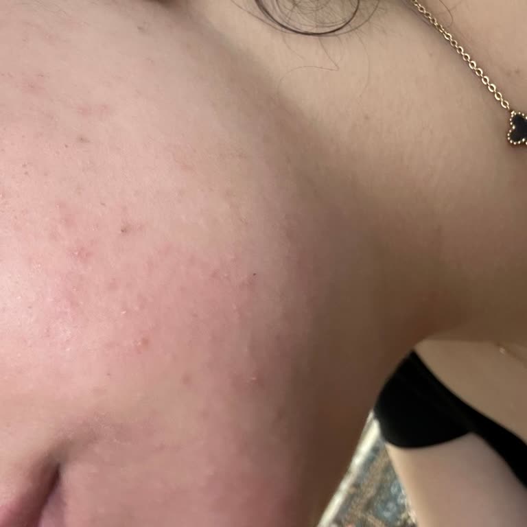 Tester Ürünler Cildimde Kızarıklık Ve Şişkinliğe Neden Oldu