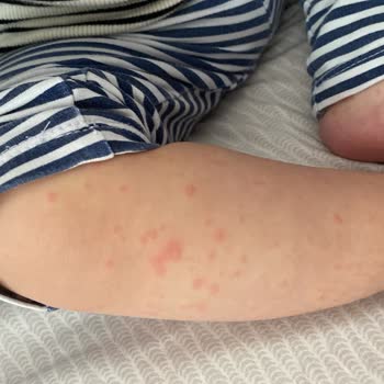 Bilim İlaç Klamoks Antibiyotik Kullanan Kızımda Şiddetli Alerjik Reaksiyon