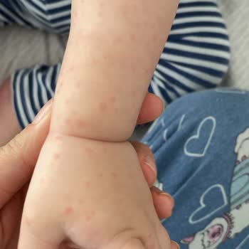 Bilim İlaç Klamoks Antibiyotik Kullanan Kızımda Şiddetli Alerjik Reaksiyon