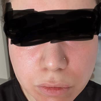 Dalin Teen Yüz Nemlendiricisi Cildimi Yaktı Ve Tahriş Etti