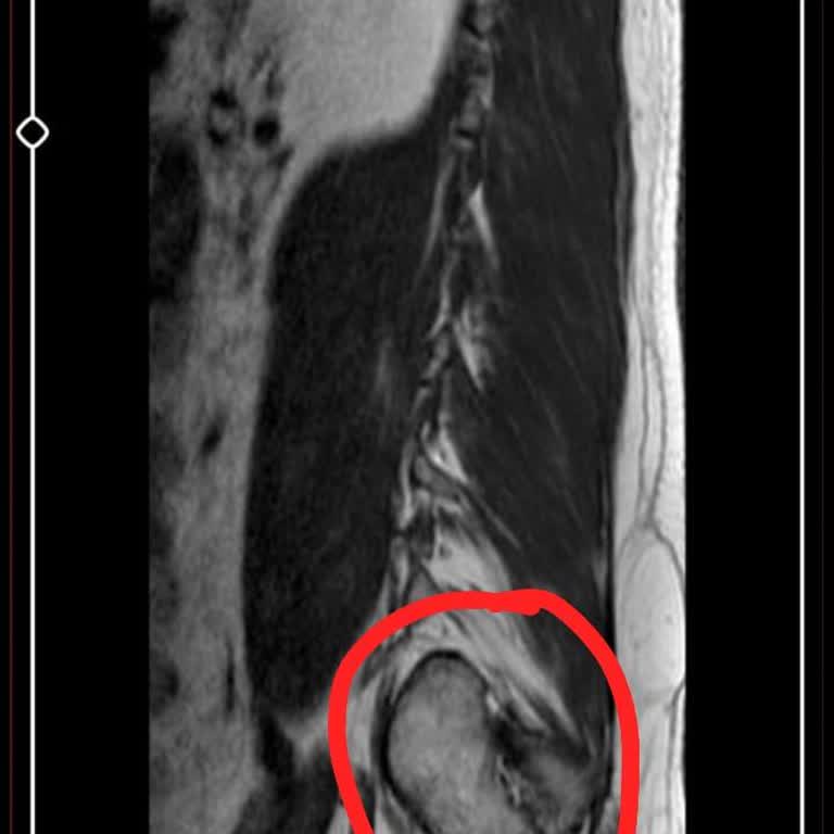Tedavi Sonrası Artan Ağrılar Ve Ücret İadesi Talebine Yanıt Verilmemesi