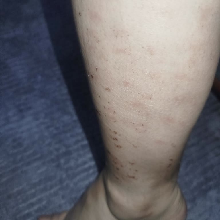 Eda Demir Beauty Center Lazer Epilasyon Sonrası Yanıklar Ve İlgisizlik Mağduriyetim