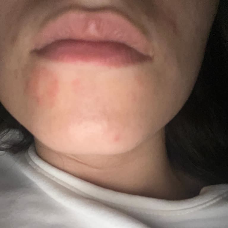 Yves Rocher Şampuan Sonrası Ciltte Kaşıntı Ve Kabarma Sorunu