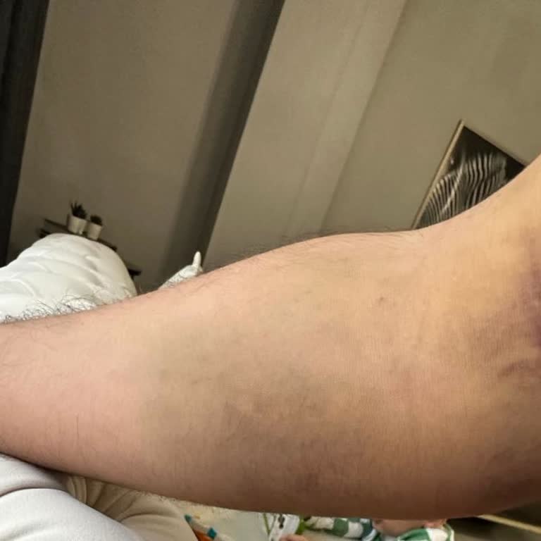 Çam Sakura Şehir Hastanesi Kan Bağışı Sonrası Ağrı Ve Morarma!