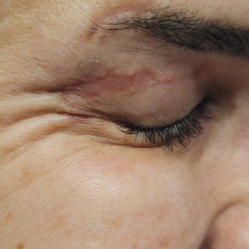 Göz Kapağı Ameliyatı Sonrası Kalıcı İzler Ve Sağlık Sorunları Yaşadım