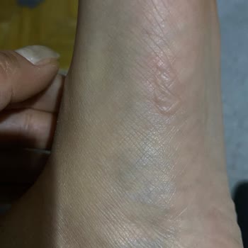 Kısa Sürede Ayağımı Rahatsız Eden Üründe İade Sorunu Ve Yetersiz Destek