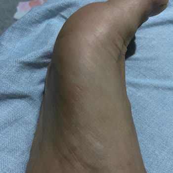 Kısa Sürede Ayağımı Rahatsız Eden Üründe İade Sorunu Ve Yetersiz Destek