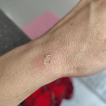 Simfer Mini Fırında Izgara Teli Sorunu Ve Yanık Mağduriyeti