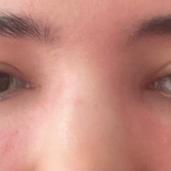 Neutrogena Hydro Boost Makyaj Temizleme Suyu Ciltte Şişlik Ve Tahrişe Sebep Oldu