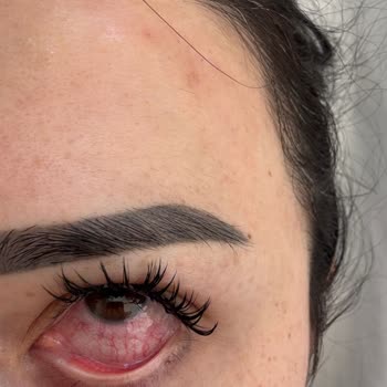 Göz Enfeksiyonu Ve İlgisiz Hizmet Nedeniyle Hayal Kırıklığı