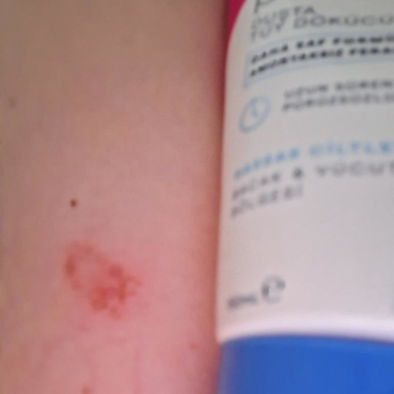 Tüy Dökücü Krem Cildimi Yaktı