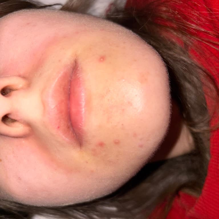 Kurtsan İlaçları Cilt Ürününde Yanma ve Sivilce Artışı Endişesi