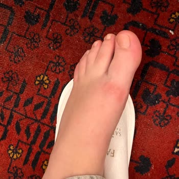 Yeni Aldığım Ayakkabı Ayağımda Ciddi Yaralara Sebep Oldu