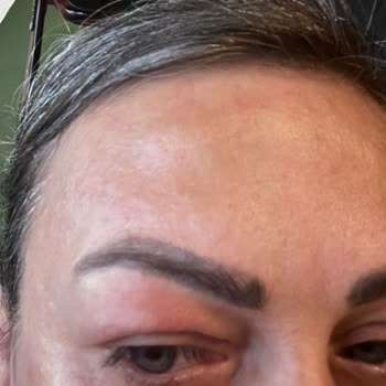 Purest C Vitamini Ciltte Alerjik Reaksiyona Sebep Oldu