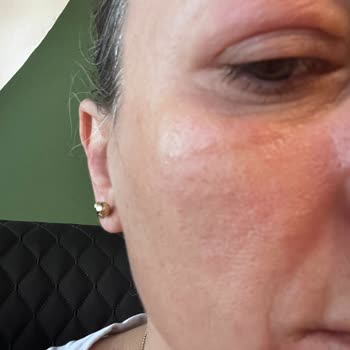 Purest C Vitamini Ciltte Alerjik Reaksiyona Sebep Oldu