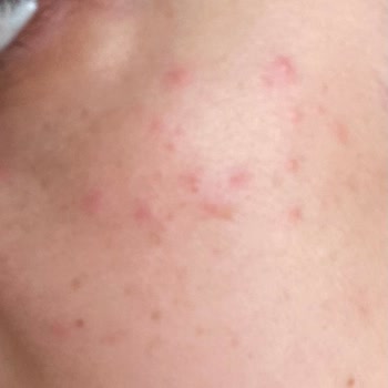 Güzellik Merkezinde Yapılan İşlemler Sonrası Cilt Sorunlarım Arttı, Mağdur Oldum