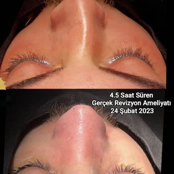 Atakent Orhangazi Tıp Merkezi Başarısız Burun Ameliyatı Sonrası Yaşanan Mağduriyet