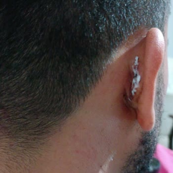 Atakent Orhangazi Tıp Merkezi Başarısız Burun Ameliyatı Sonrası Yaşanan Mağduriyet