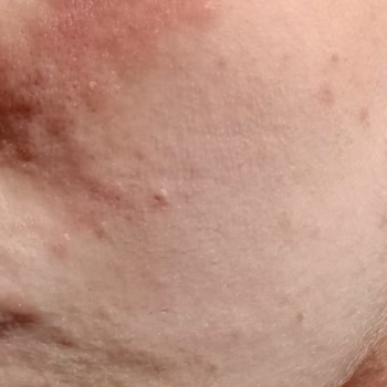 Bepanthol Krem Yüzünde Kızarıklık Ve Kabarma Yaptı, Okula Gidemedi