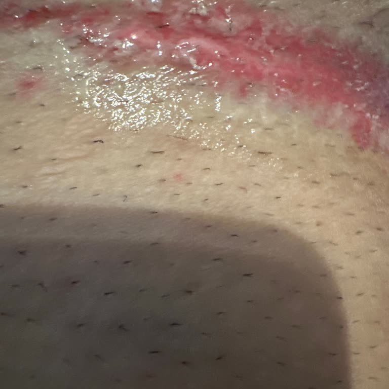 Veet Tüy Dökücü Krem Ciddi Tahrişe Yol Açtı, Mağdur Oldum