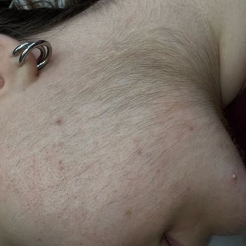 Lazer Tedavisinde Beklentilerim Karşılanmadı, Sonuçlar Olumsuz Oldu