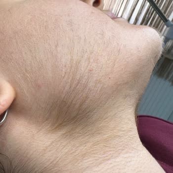 Lazer Tedavisinde Beklentilerim Karşılanmadı, Sonuçlar Olumsuz Oldu